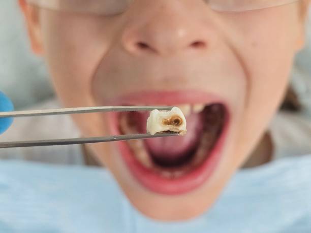 Best Emergency Root Canal Treatment in East Camden, SC